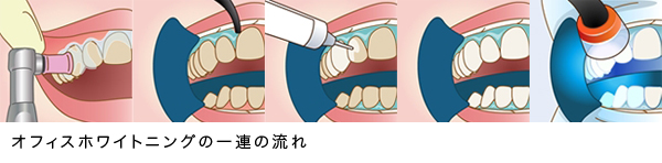 オフィスホワイトニング